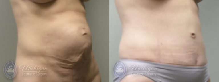 Tummy Tuck Before and After Photo by Dr. Awada in Southfield Michigan