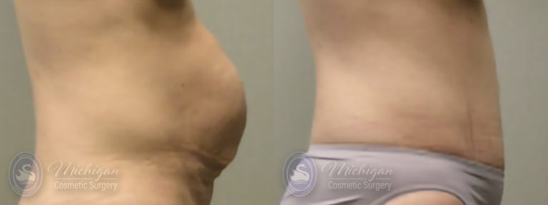 Tummy Tuck Before and After Photo by Dr. Awada in Southfield Michigan