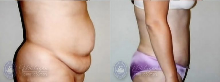 Tummy Tuck Before and After Photo by Dr. Awada in Southfield Michigan