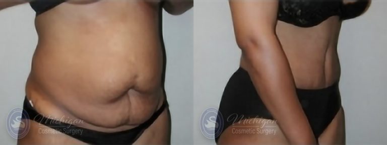 Tummy Tuck Before and After Photo by Dr. Awada in Southfield Michigan