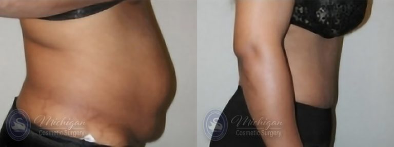 Tummy Tuck Before and After Photo by Dr. Awada in Southfield Michigan
