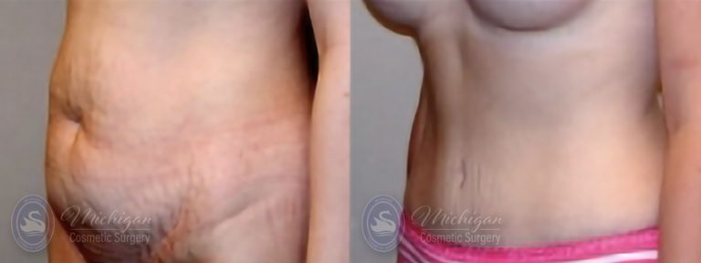 Tummy Tuck Before and After Photo by Dr. Awada in Southfield Michigan
