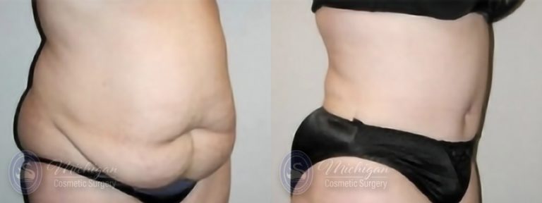 Tummy Tuck Before and After Photo by Dr. Awada in Southfield Michigan