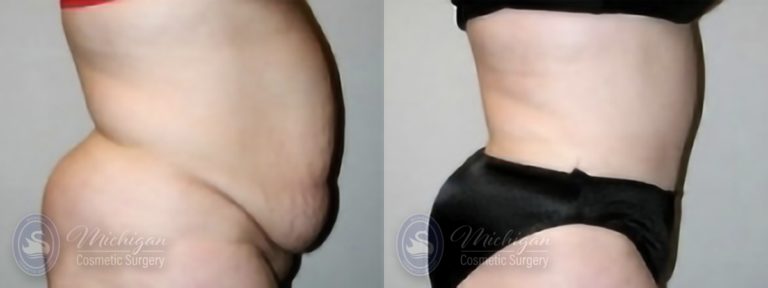 Tummy Tuck Before and After Photo by Dr. Awada in Southfield Michigan