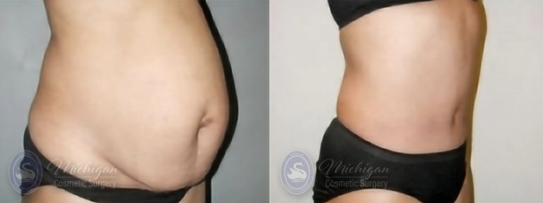 Tummy Tuck Before and After Photo by Dr. Awada in Southfield Michigan