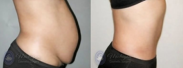 Tummy Tuck Before and After Photo by Dr. Awada in Southfield Michigan