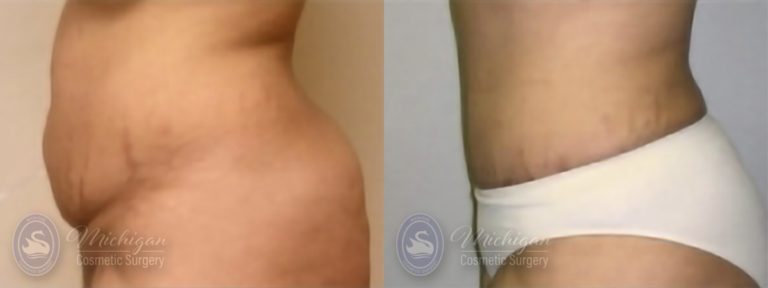 Tummy Tuck Before and After Photo by Dr. Awada in Southfield Michigan