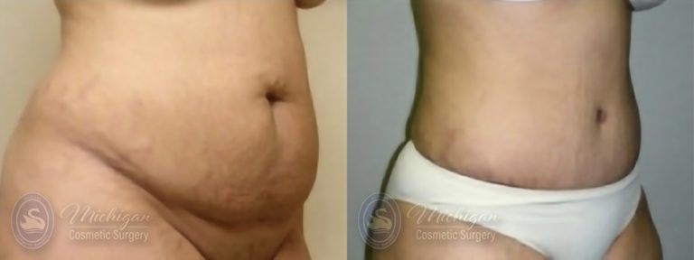 Tummy Tuck Before and After Photo by Dr. Awada in Southfield Michigan