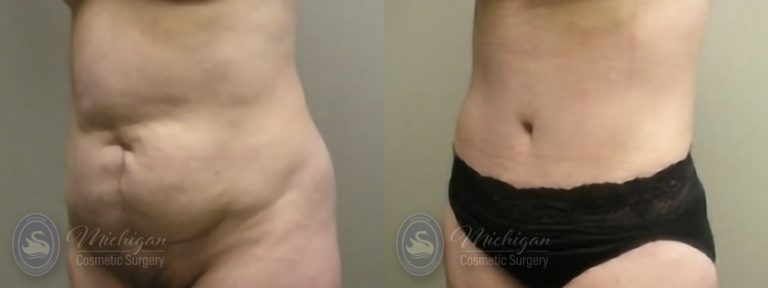 Tummy Tuck Before and After Photo by Dr. Awada in Southfield Michigan