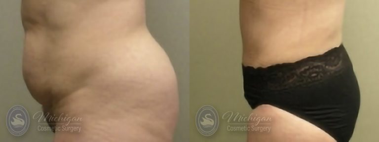 Tummy Tuck Before and After Photo by Dr. Awada in Southfield Michigan