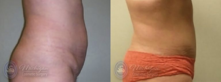 Tummy Tuck Before and After Photo by Dr. Awada in Southfield Michigan