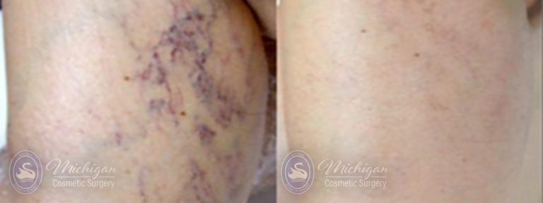 Vein Removal Before and After Photo by Dr. Awada in Southfield Michigan