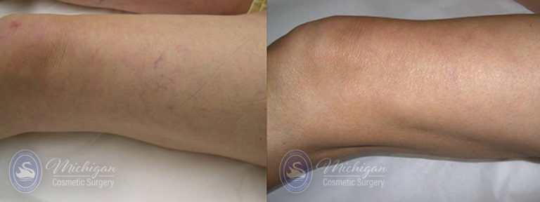 Vein Removal Before and After Photo by Dr. Awada in Southfield Michigan