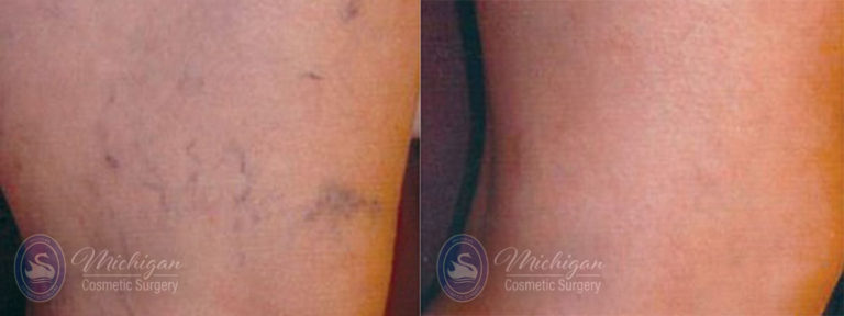 Vein Removal Before and After Photo by Dr. Awada in Southfield Michigan