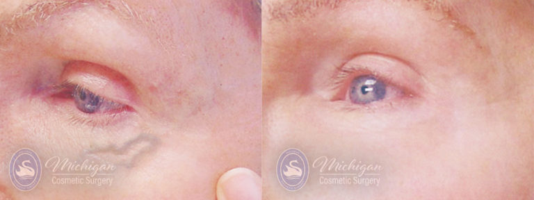Vein Removal Before and After Photo by Dr. Awada in Southfield Michigan