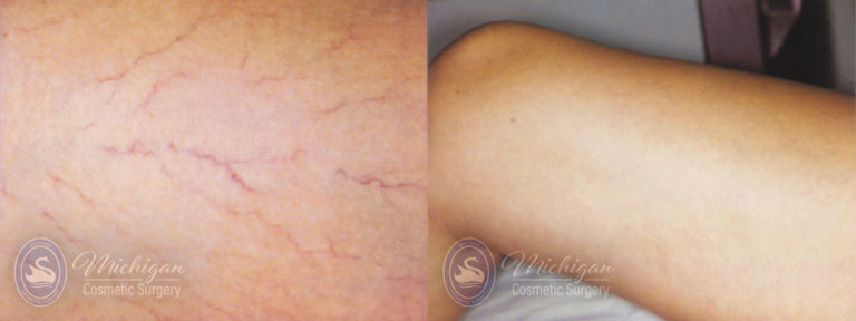 Vein Removal Before and After Photo by Dr. Awada in Southfield Michigan