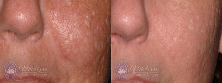 Acne Removal Before and After Photo by Dr. Awada in Southfield Michigan