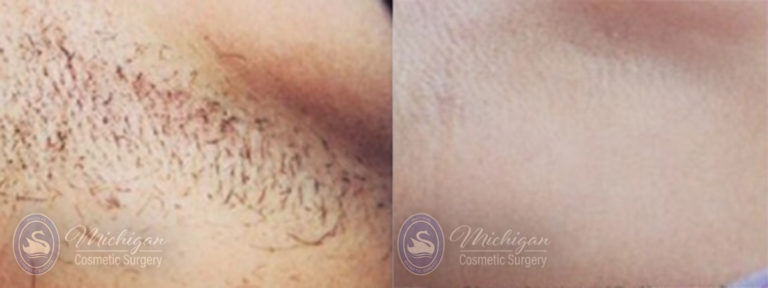 Laser Hair Removal Before and After Photo by Dr. Awada in Southfield Michigan