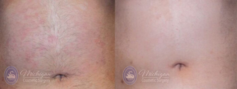 Laser Hair Removal Before and After Photo by Dr. Awada in Southfield Michigan