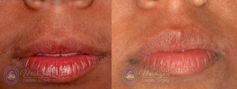Laser Hair Removal Before and After Photo by Dr. Awada in Southfield Michigan