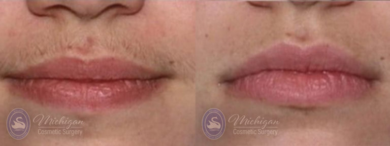 Laser Hair Removal Before and After Photo by Dr. Awada in Southfield Michigan