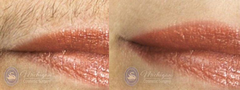 Laser Hair Removal Before and After Photo by Dr. Awada in Southfield Michigan