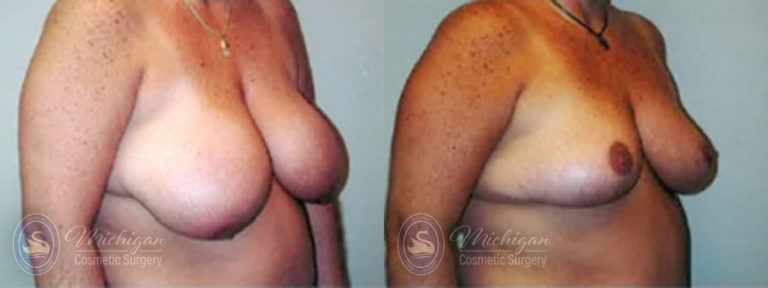 Breast Lift Before and After Photo by Dr. Awada in Southfield Michigan