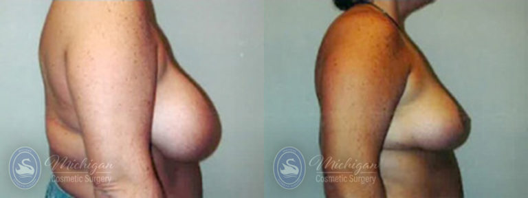 Breast Lift Before and After Photo by Dr. Awada in Southfield Michigan