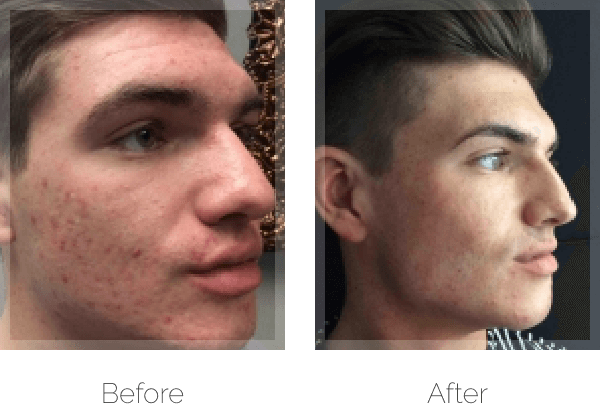 Acne treatment before & after