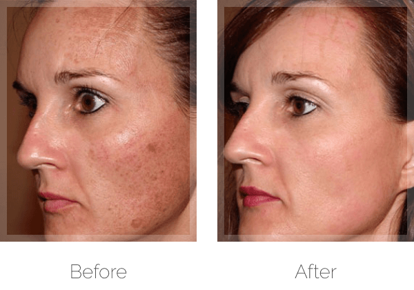Non-surgical Pigment Reduction Before & After