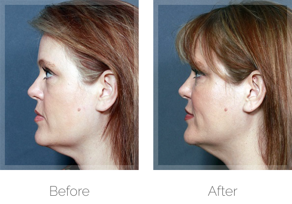 Non-Surgical Skin Tightening Before & After Photos in Michigan