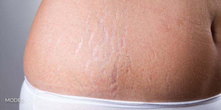 Female belly with stretch marks closeup on a gray background