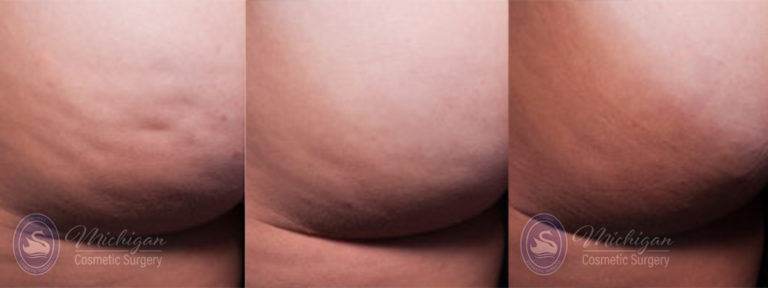 Cellulite Treatment Before and After Photo by Dr. Awada in Southfield Michigan