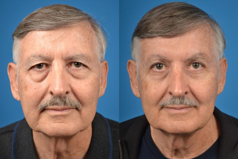 Brow Lift Before and After Photo by Dr. Awada in Southfield Michigan