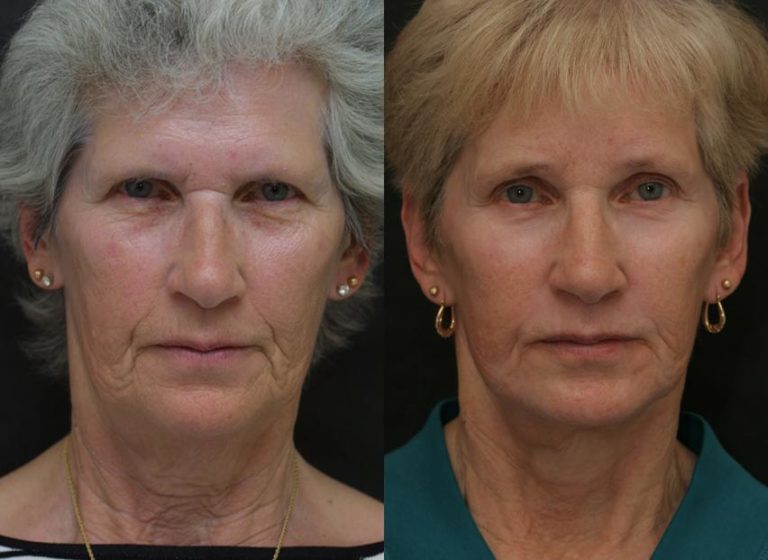 Brow Lift Before and After Photo by Dr. Awada in Southfield Michigan